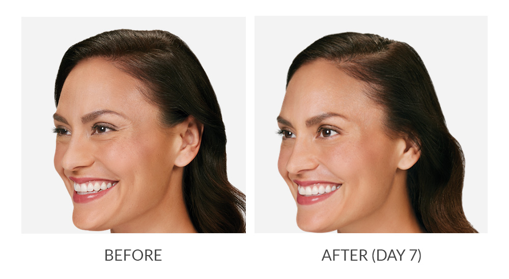Botox before and after photo 4