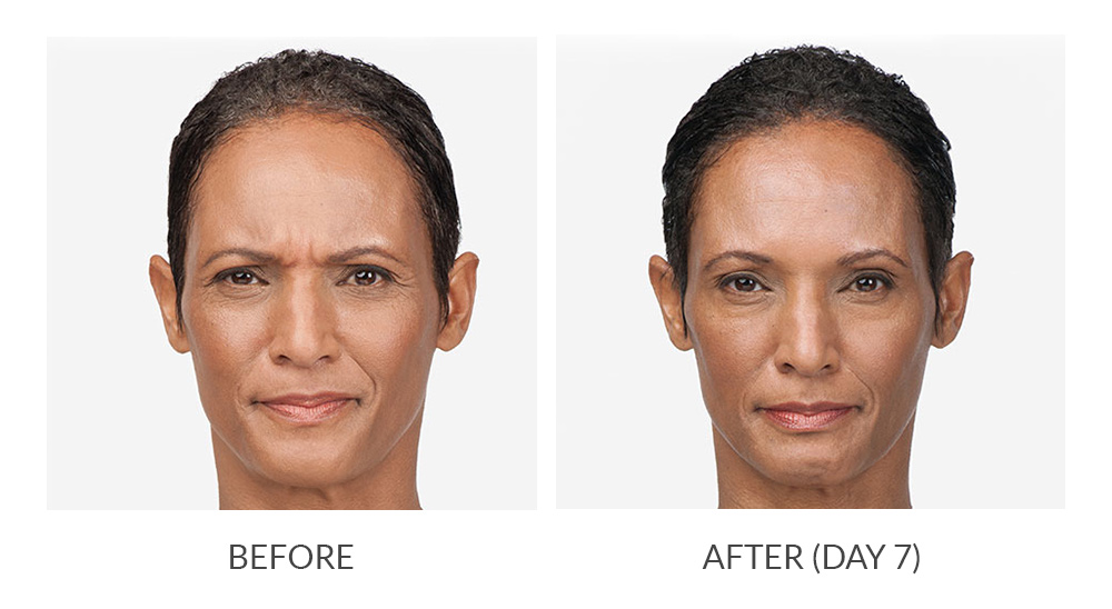 Botox before and after photo 3