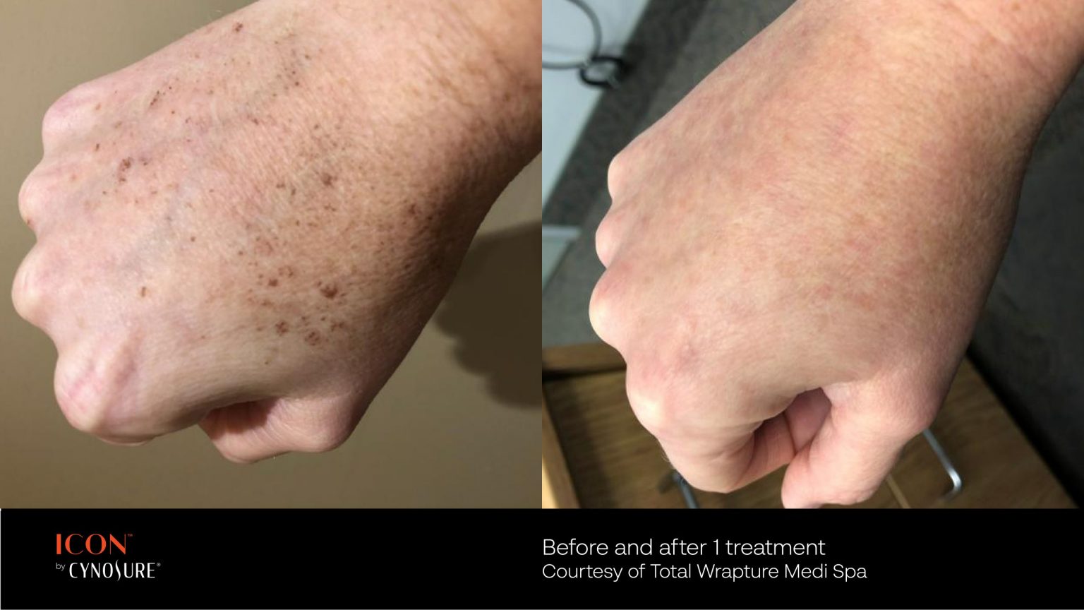IPL before and after photo 4