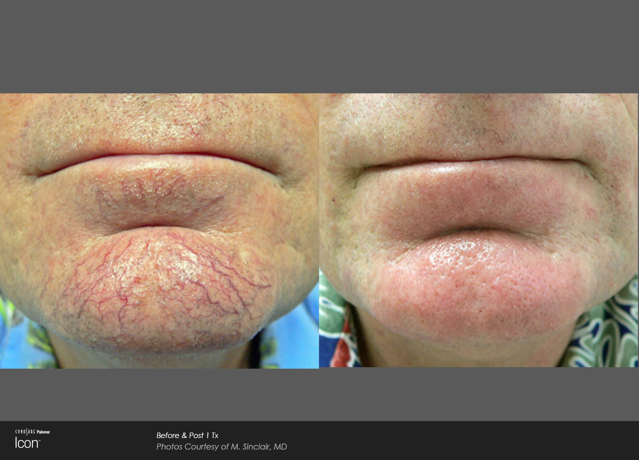 IPL before and after photo 2