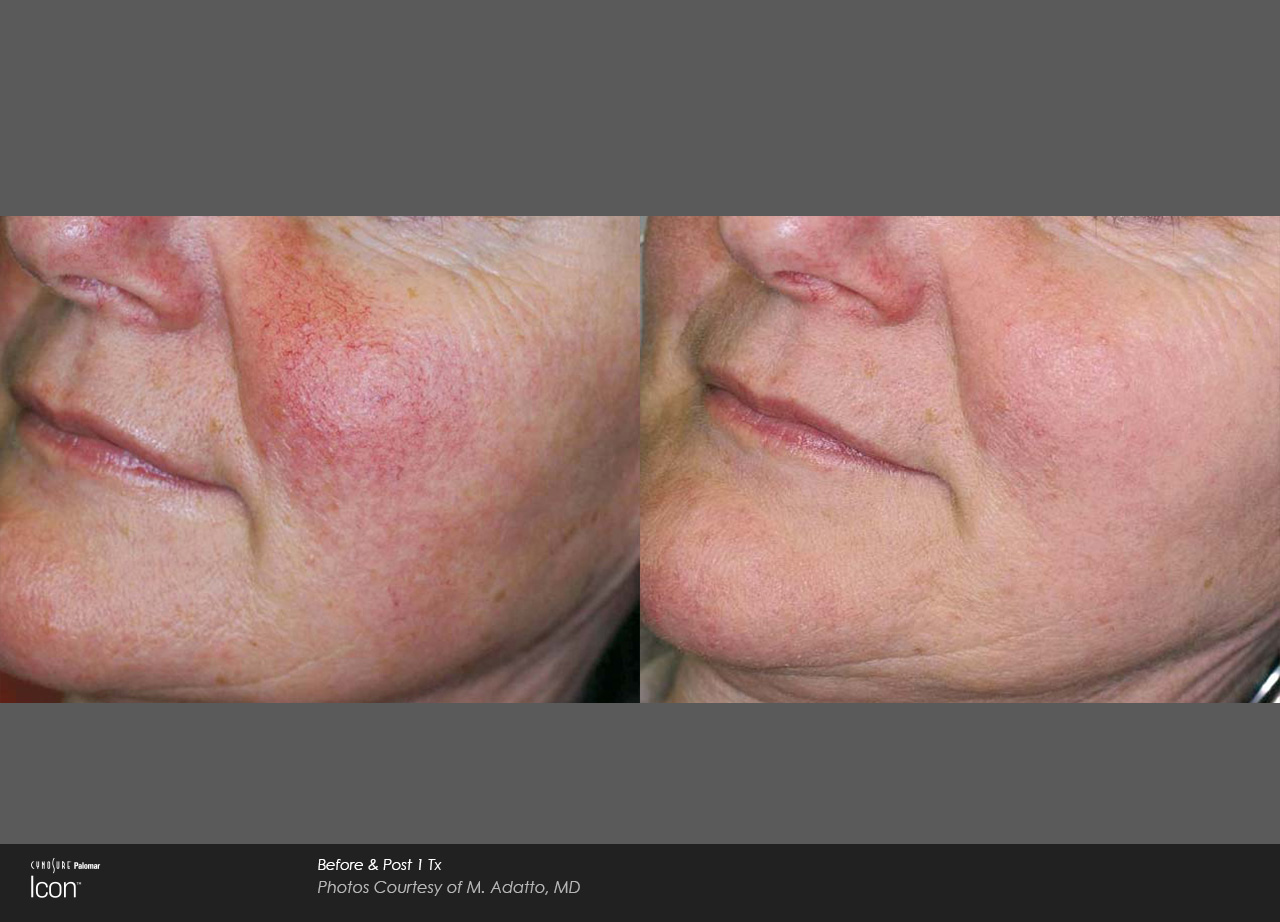 IPL before and after photo 3