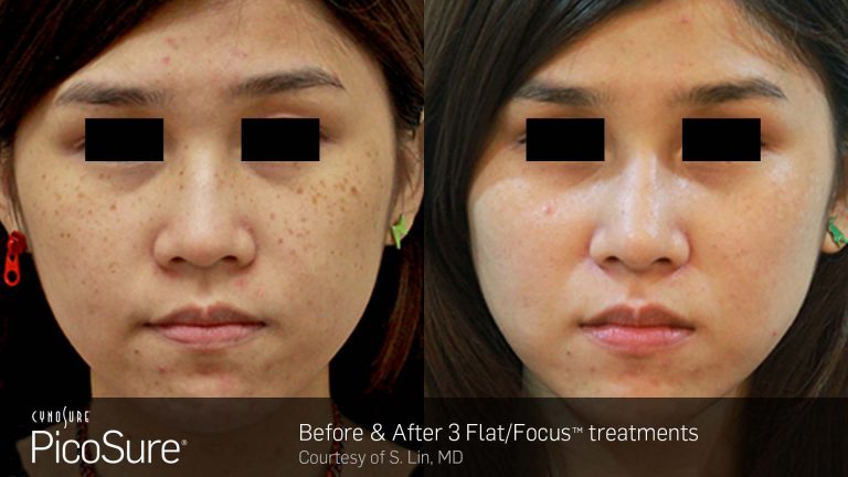 PicoSure result photo 5