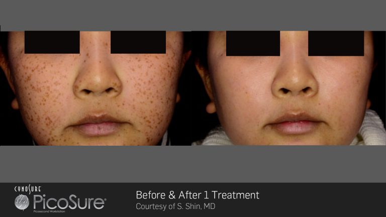 PicoSure result photo 3