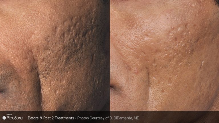 PicoSure result photo 4