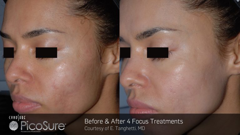 PicoSure result photo 2