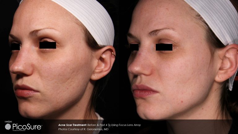 PicoSure result photo 1