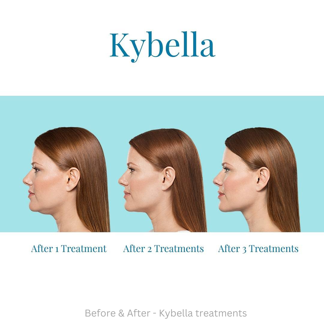 Kybella treatments