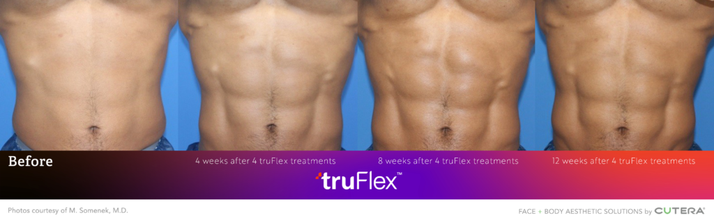 TruFlex body sculpting before and after treatment example
