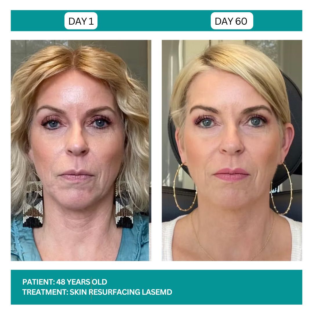 Before and after example showing skin tone and texture improvement after laser resurfacing