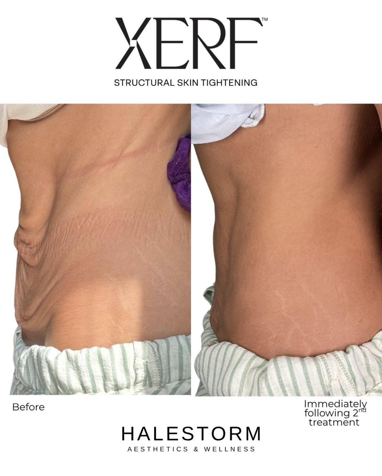XERF RF skin tightening treatment technology